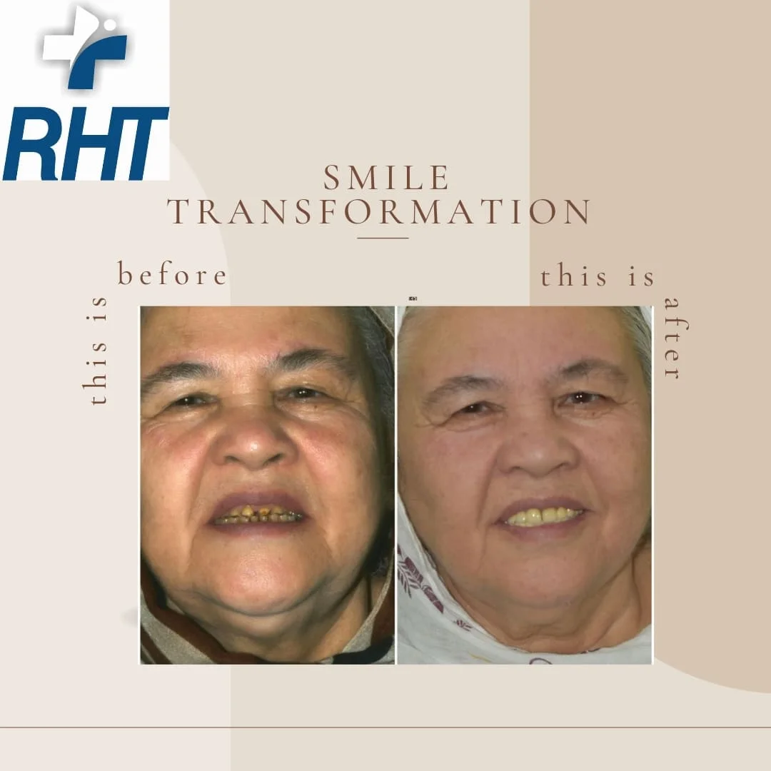 Dental implants by best dentist