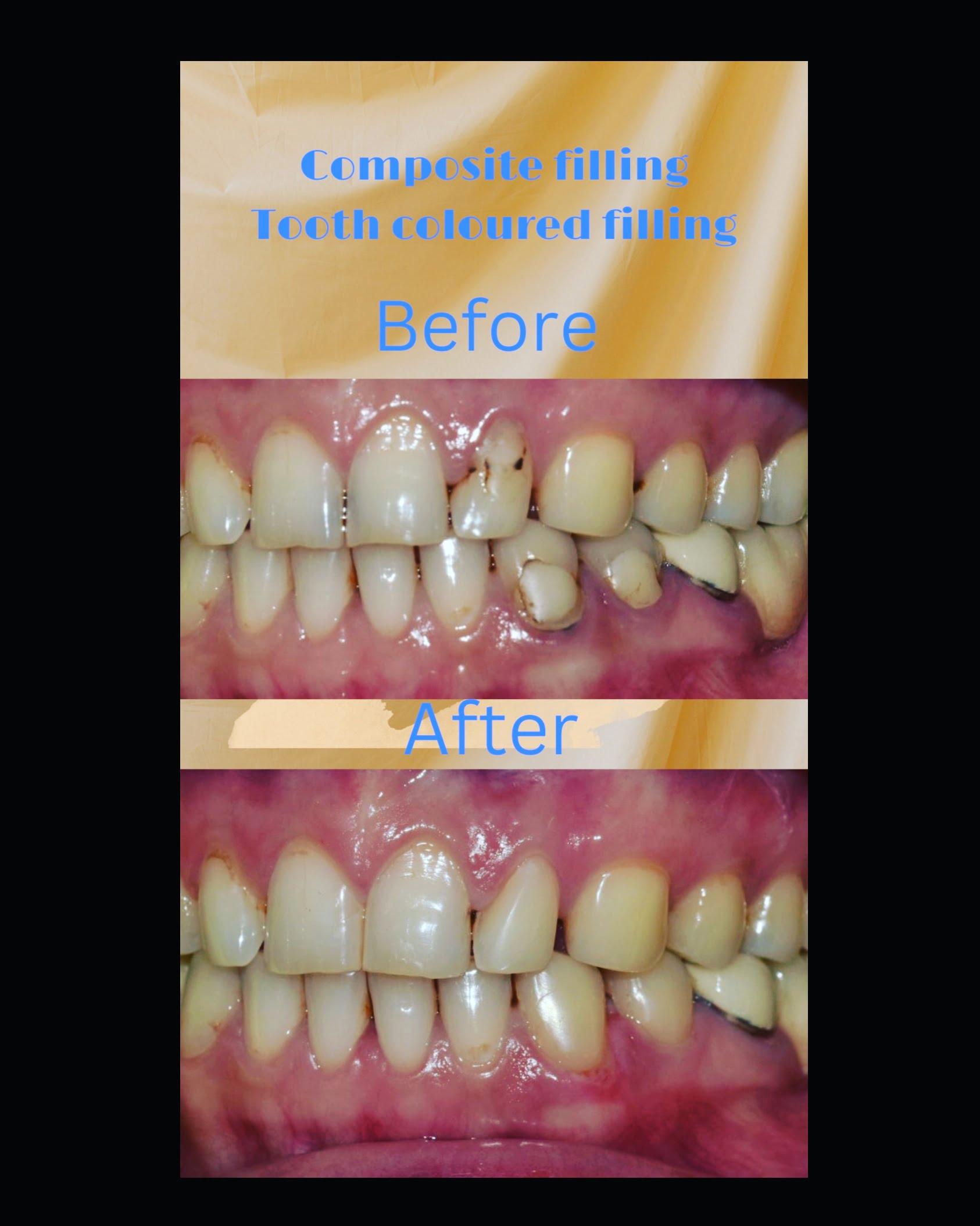 Teeth Cleaning and polishing