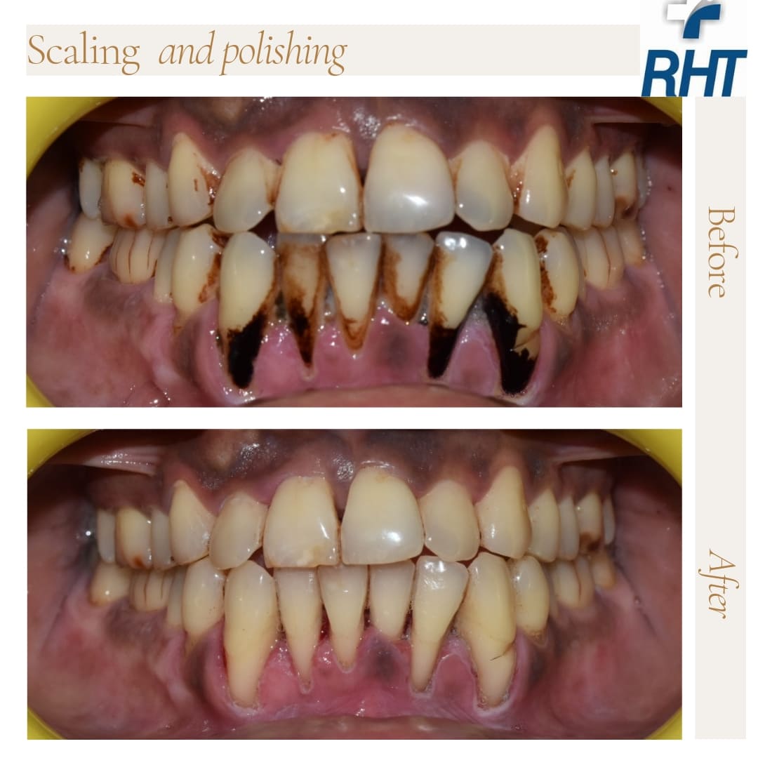 Scaling by best dentist