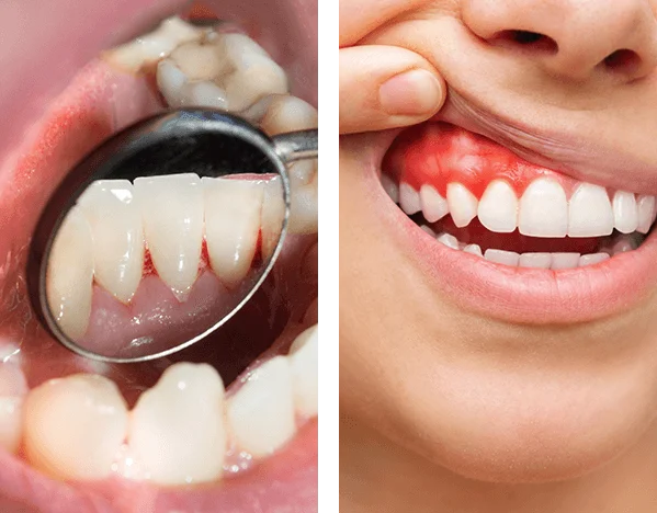 Periodontal (gum) Treatment