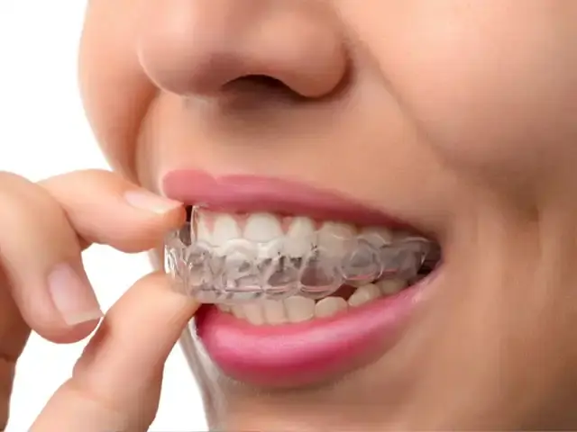 Invisalign- Clear aligners