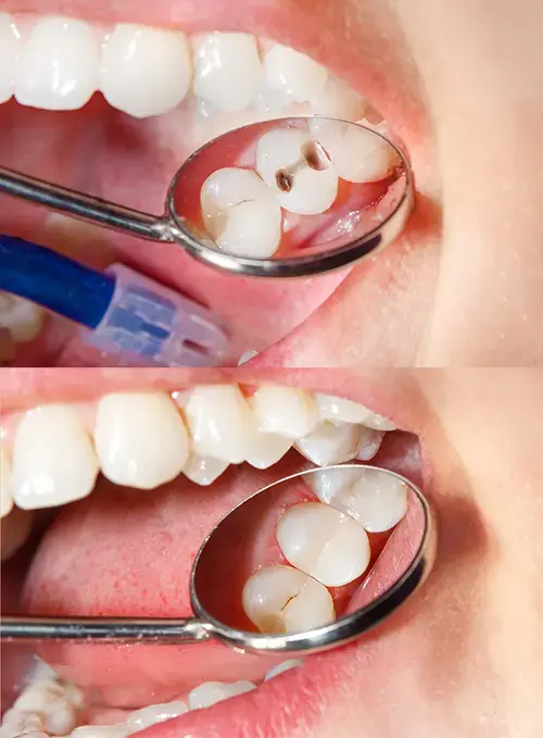 Dental filling