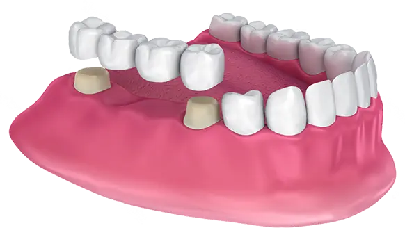 Dental crowns and bridges