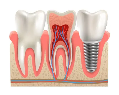 Dental implants