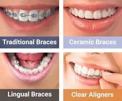 braces and aligners