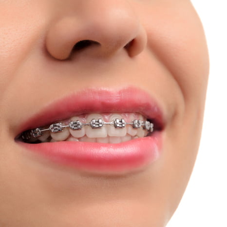 Dental Braces – A Personal Note on Straighter Smiles
