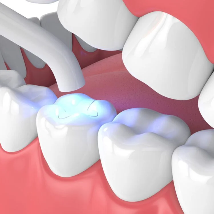 Tooth Filling