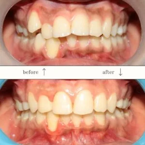 Orthodontic Treatment