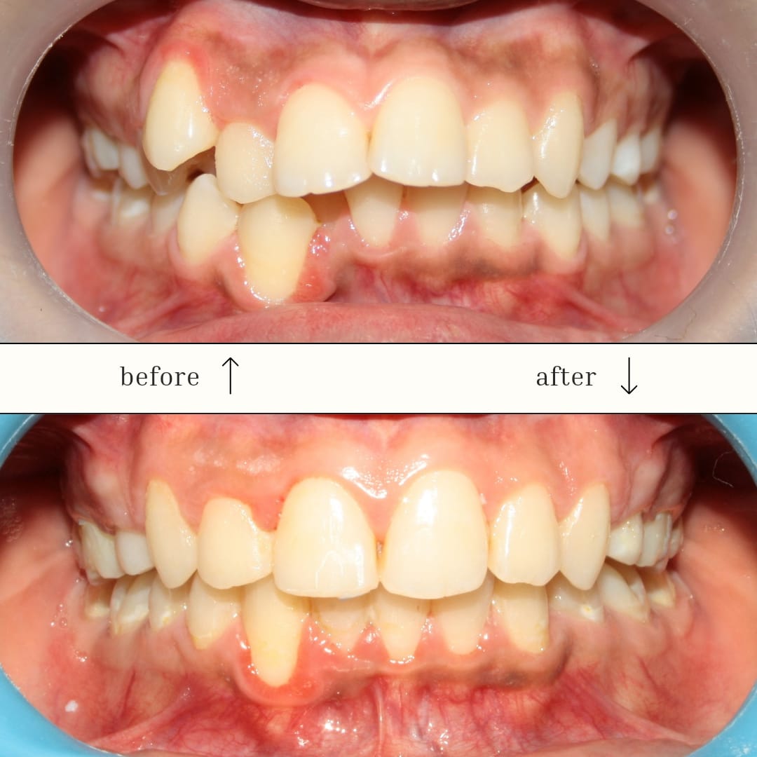 Orthodontic Treatment