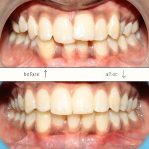 orthodontic treatment