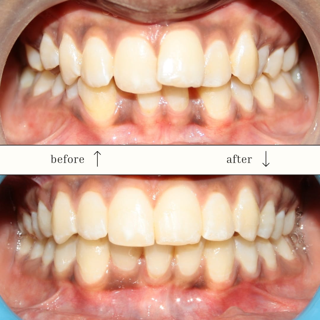 orthodontic treatment