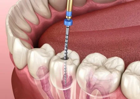 Root Canal Treatment (RCT)