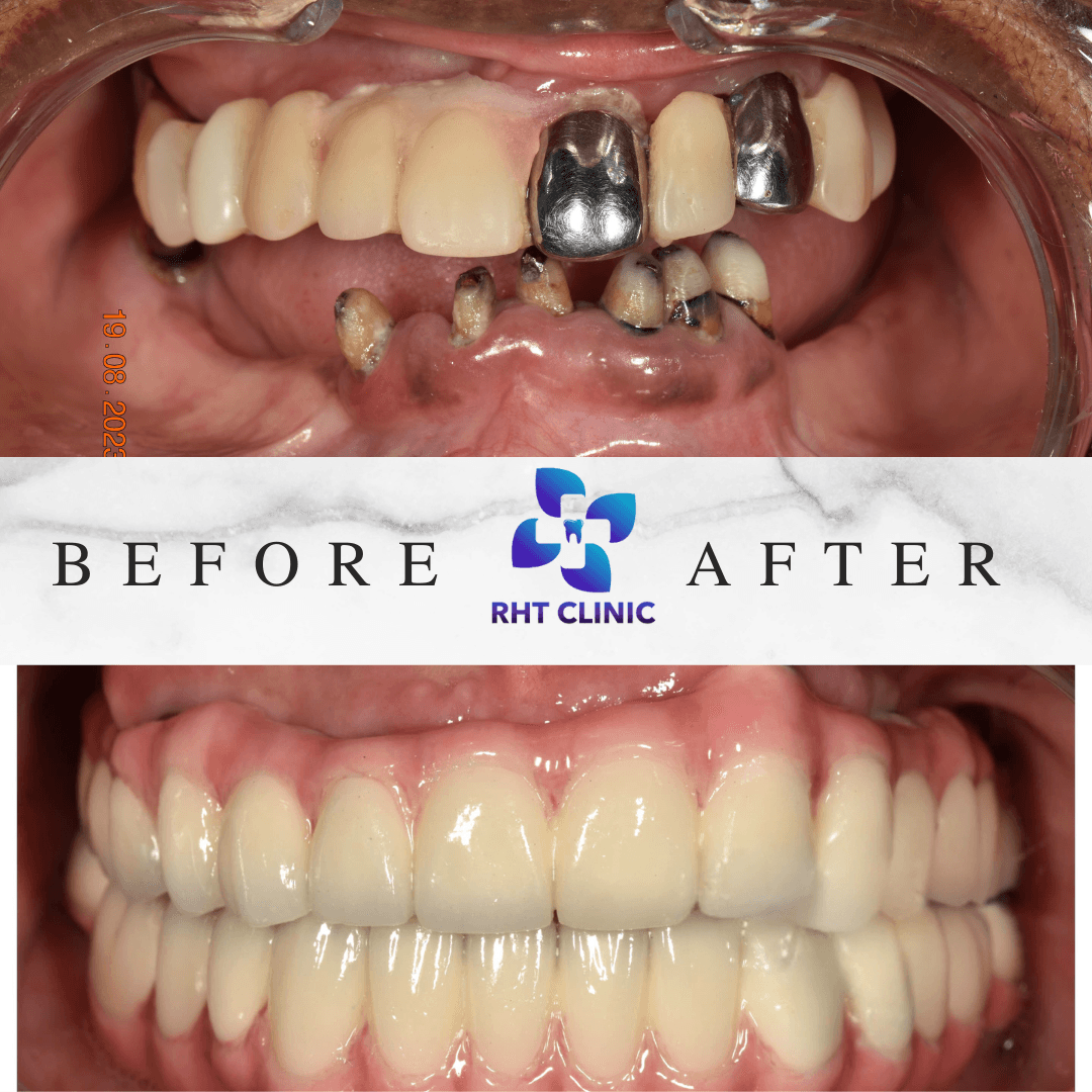 Best Dentist in Dental Implant