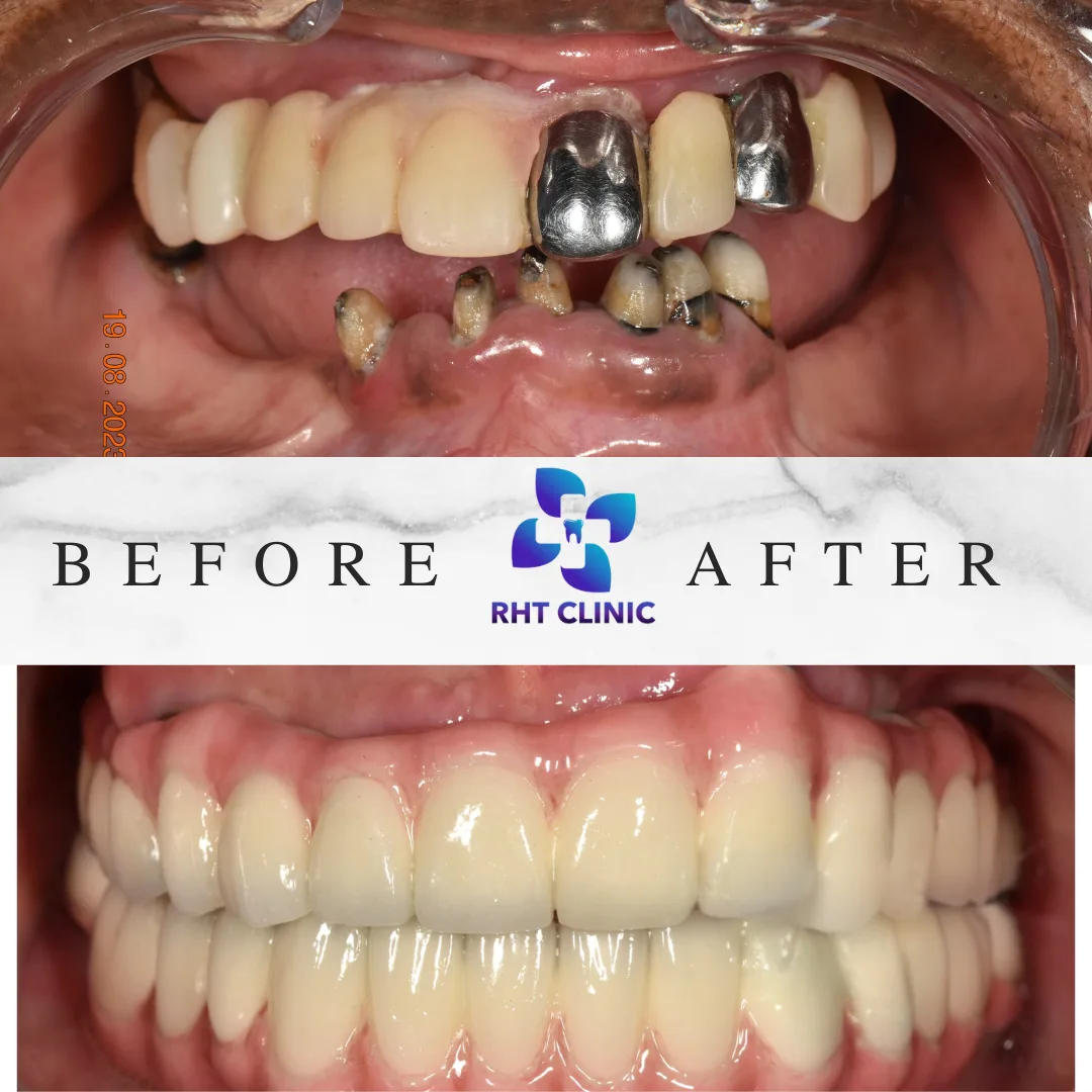 Best Dentist in Dental Implant