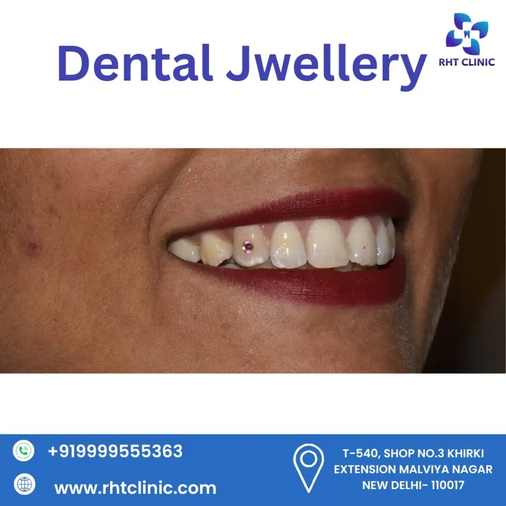 Dental Jwellery