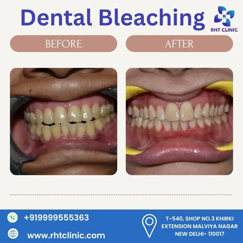 Dental Bleaching