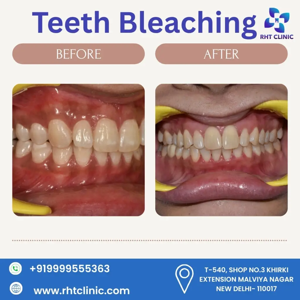 Teeth Bleaching